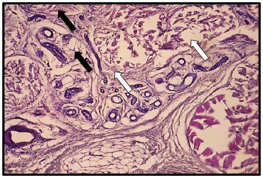 Figure 11 : Photomicrograph of skin tissue from Group III showeddilated acini of the sweat glands with degenerative changes of their lining epithelium (black arrows) and dilatation