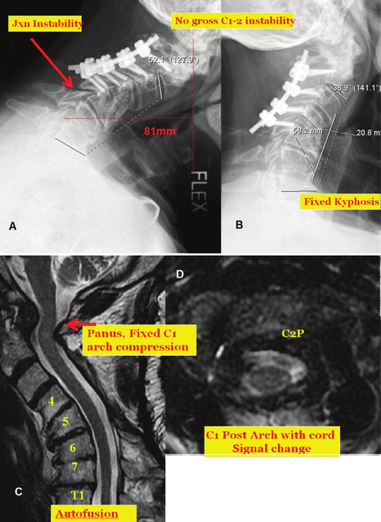 S. Hann et al. Fig. 11. Case 3. Preoperative images. A: Flexion cervical radiograph showing junctional (Jxn) instability and kyphosis at the level below the fusion; the Cobb angle was 52.