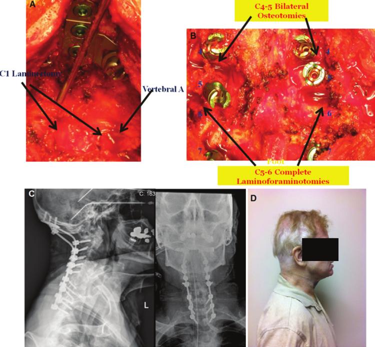 Algorithmic selection of cervical deformity surgery Fig. 12. Case 3. Intraoperative and postoperative images. A: Intraoperative photograph of occipital instrumentation and C-1 decompression.