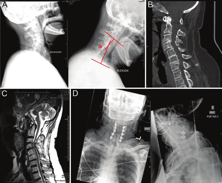 Algorithmic selection of cervical deformity surgery Fig. 16. Case 6. A: Preoperative cervical radiographs showing postlaminectomy kyphosis that is worst at C4 5. The Cobb angle is 13.