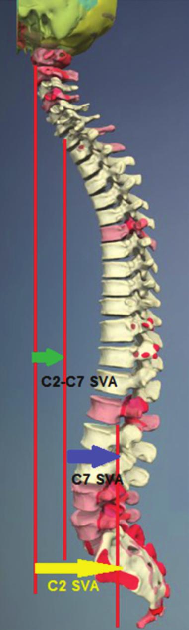 S. Hann et al. trally, it has been emphasized that dorsal instrumentation alone is not effective in restoring CL; rather, it only serves to help in reduction of degree of kyphosis.