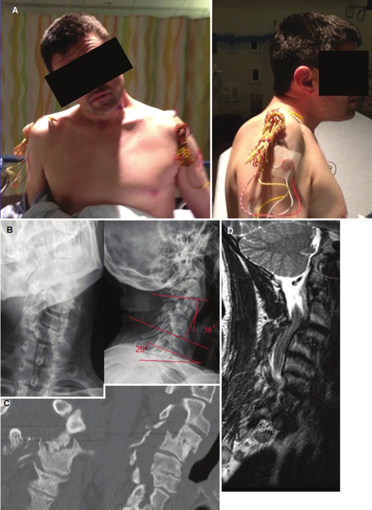 S. Hann et al. Fig. 9. Case 2. Preoperative images. A: Preoperative clinical photographs demonstrating neutral CBVA in a patient with coronal and sagittal imbalance.