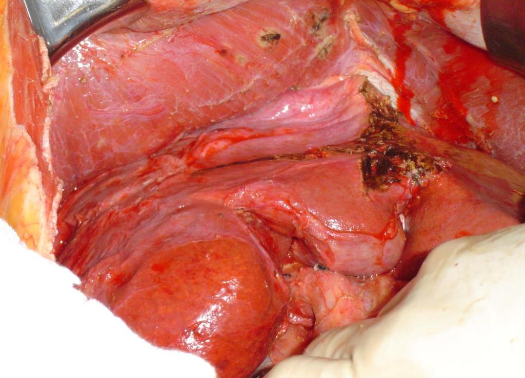 Stripping of the Parietal Peritoneum All involved parietal peritoneum is removed Visceral peritoneum: