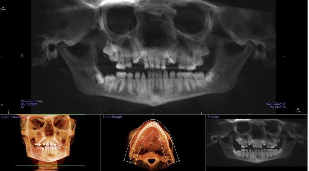 Impressions: 1. Mild to moderate maxillary sinusitis. Hypoplstic right maxillary sinus.
