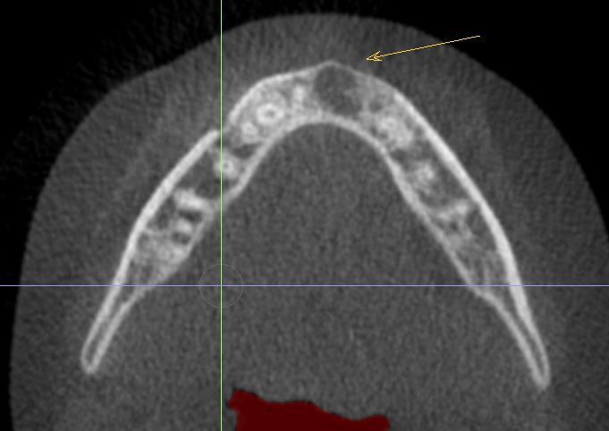 mandibular anterior region