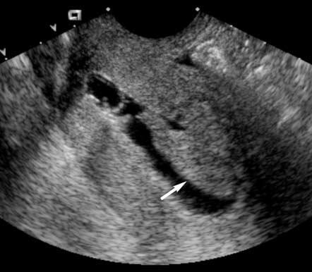 Sonohysterography of the Endometrium in Tamoxifen-Treated Women The sensitivity (true-positive fraction) of endometrial biopsy was only 4% (1 of 24) with a confidence interval of 0% to 21%, whereas