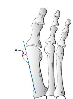 1.11.6 Other radiographic measurers of the hallux valgus 1.11.6.1 Medial Eminence The size of the medial eminence should be evaluated in a patient with hallux valgus deformity.