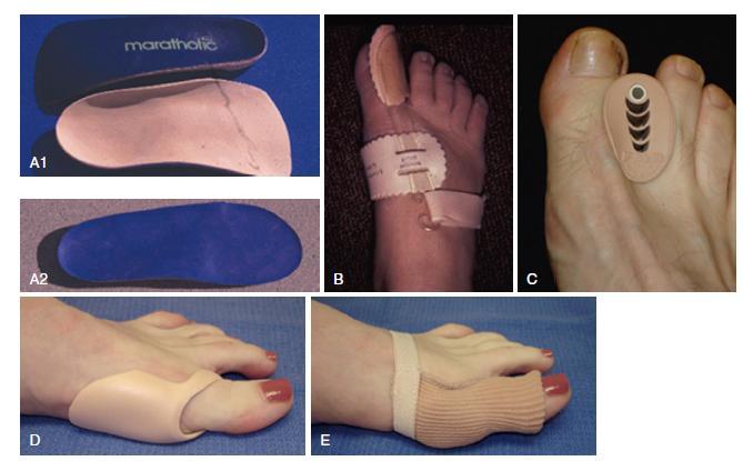 Figure 1.14: Some of the available devices for conservative management of hallux valgus 1 1.14.2 Surgical management More than a hundred of surgical procedures have been described for treating the hallux valgus.