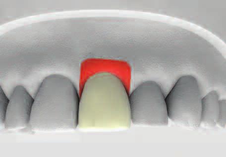 Use positioning jig to transfer the abutment from