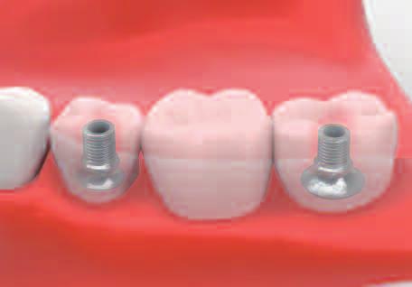 Place wax into the opening of the abutment to