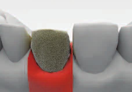 Use positioning jig to transfer the abutment