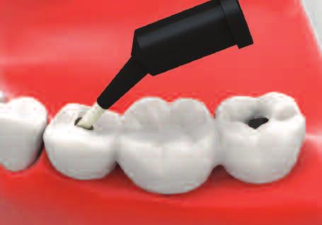 repair In order to unscrew, create access hole on the occlusal surface with a bur.