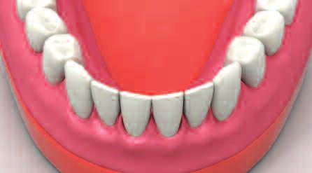Remove the denture after the resin is fully set.