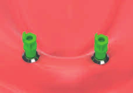 Connect the Ball Abutment with the