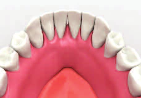 Case 2 Female sockets are placed in the denture.