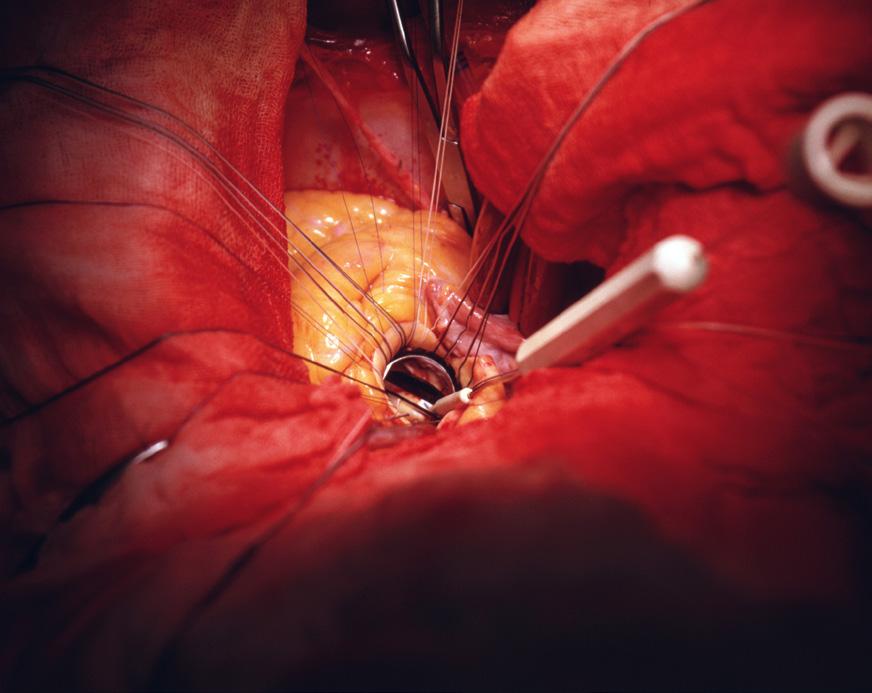 Myocardial Infarction Geriatric Cardiology