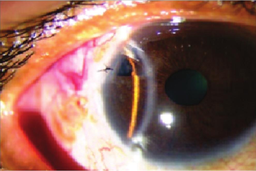 In the control group (15 eyes) trabeculectomy with MMC with two releasable sutures was performed.
