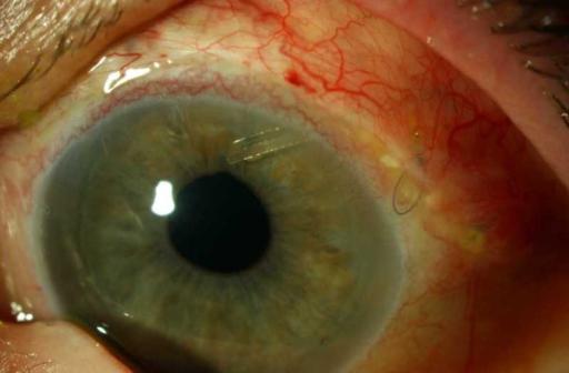 2. HOW WILL THE SHUNT AFFECT THE EXTERNAL APPEARANCE OF THE EYE? On the outside of the eye Initially after surgery, the eye will be red and swollen to a variable degree.