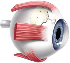 When the shunt is functioning normally, the drained fluid accumulates in a blister or bleb in the conjunctiva that is hidden by the eyelid.