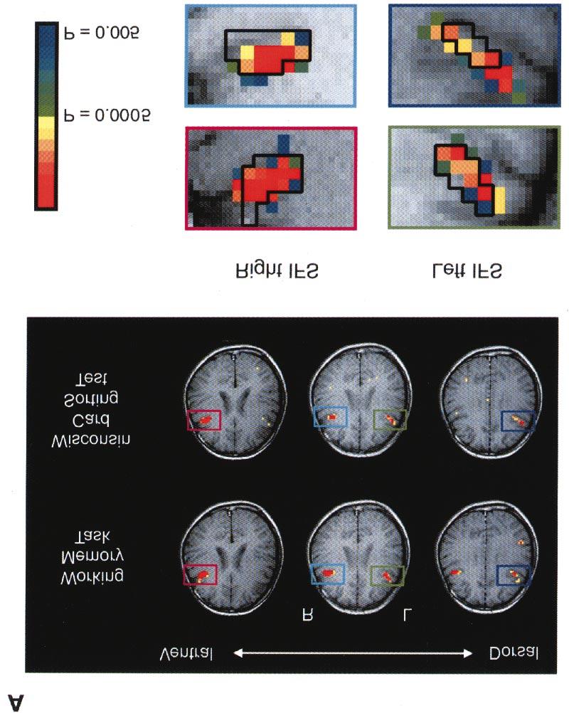 Figure 5. Spatial overlap of the inferior prefrontal areas activated in the working memory task and the WCST.
