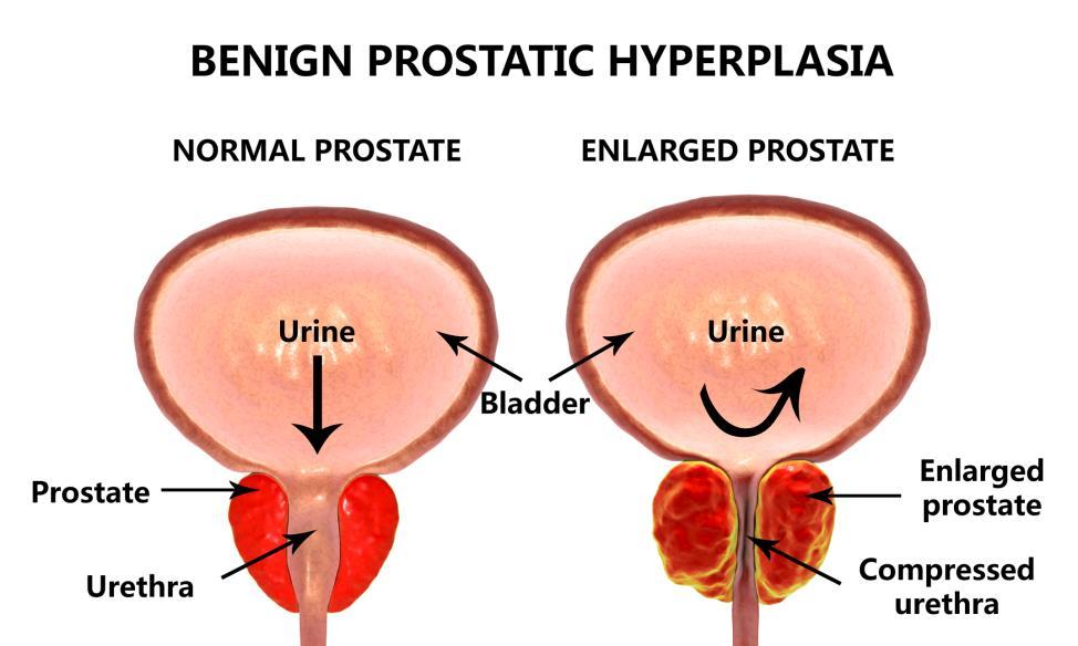 6-Urinary Obstruction Benign prostatic hyperplasia (BPH) is common in elderly men.
