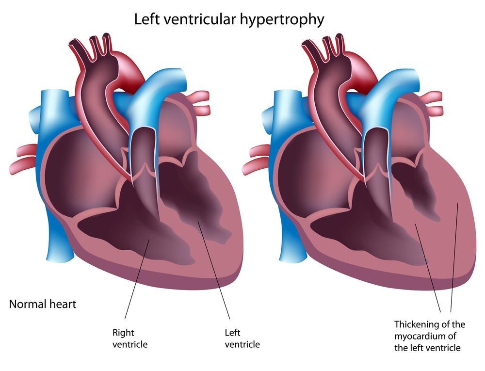 Hypertrophic Cardiomyopathy propranolol reduces the incidence of sudden death in patients with hypertrophic cardiomyopathy (HCM).