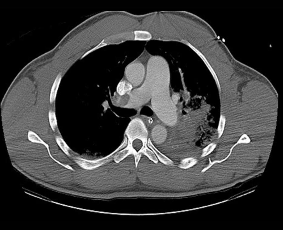 Figure 1. CT pulmonary angiography demonstrating a large embolus lodged in the right main pulmonary artery with dilation of the pulmonary trunk.