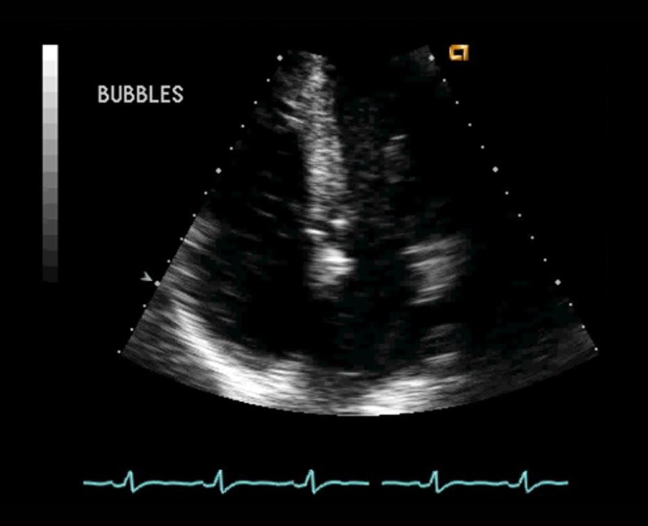 Large PFO is demonstrated by immediate passage of bubbles from the right side of the heart (viewer s left) to the left side of the heart (viewer s right). Figure 2.