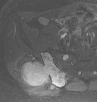 FD CT MRI, Axial T1, fat