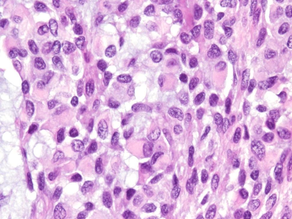 Altered Myoepithelial Cells Neoplastic