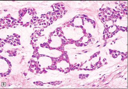 Extraskeletal Myxoid Chondrosarcoma Clinical: adults, extremity More diffusely myxoid IHC: non-contributory (weak/negative