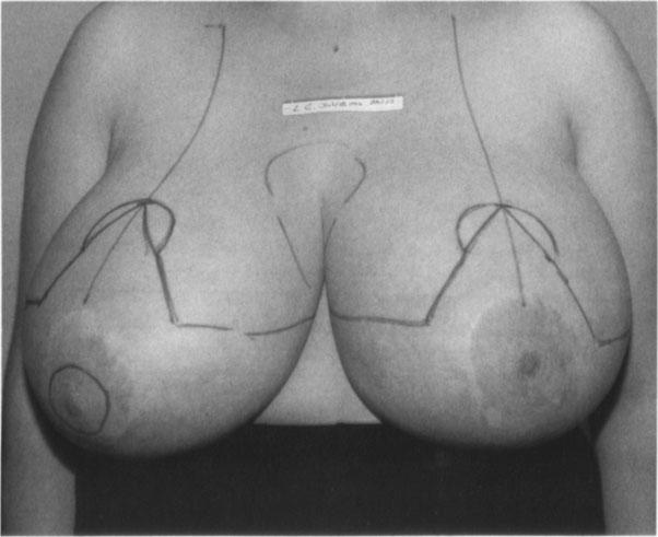 in 1988; her breasts were reduced using the standard