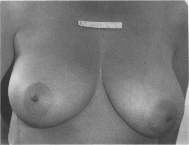 this one. t this breast length, a free nipple graft is not the best choice.