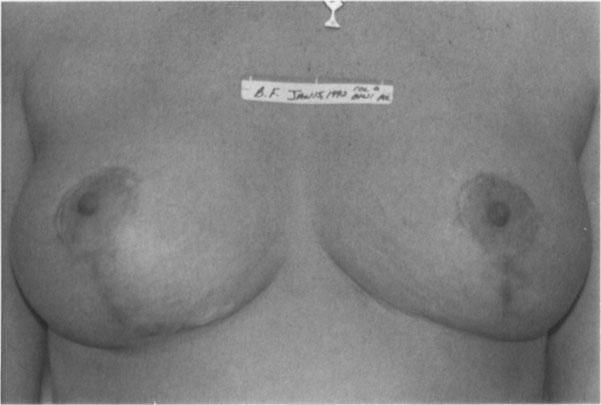 patient () with the circle procedure. In (B), the excellent elevation of the areola is shown.