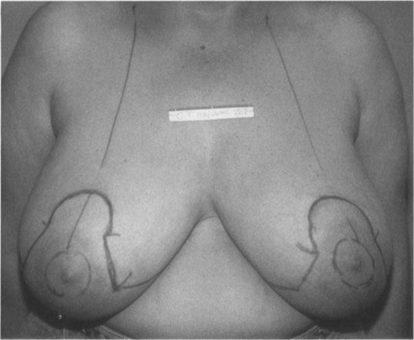 136 -:- CIRCUMREOLR TECHNIQUES FOR BREST SURGERY B c Figure 9.2. Standard reduction mammoplasty.