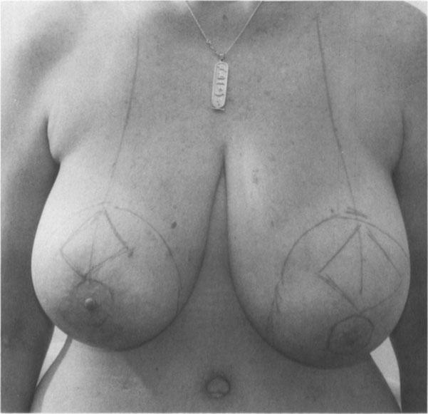 9: TECHNIQUES FOR REDUCTION OF LRGER BRESTS -:- 139 Figure 9.4. Major breast reduction in an older patient. Fortunately, this patient requested that her breasts be reduced only moderately.