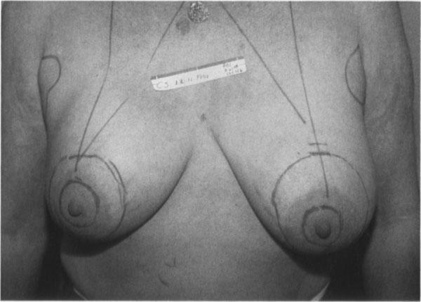 Markings for Larger Breast Reductions The markings for breast reduction are essentially the same as for smaller reductions and mastopexy, with the