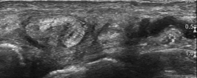 Flexor Tendon Pathology: Tendinosis with Interstitial Tear A P SAX Image provided by Dr.