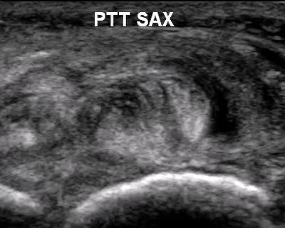 Flexor Tendon Pathology: Tendinosis with Interstitial Tear Companion case Video provided by Dr.