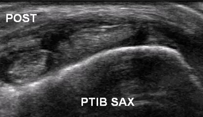 Flexor Tendon Pathology: PT Tendon Instability/Subluxation Video provided by Dr.