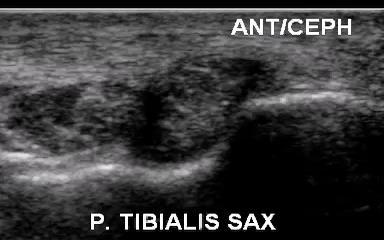 Flexor Tendon Anatomy Posterior Tibialis Video provided by Dr.
