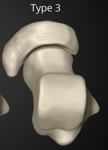 Accessory Navicular Bone Anatomy Classification Type III Prominent navicular tuberosity (cornuate