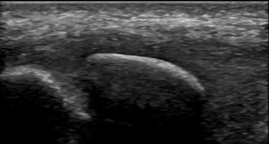 Accessory Navicular Bone Pathology: Symptomatic Os Naviculare asx D Os P Nav LAX Image provided by Dr.