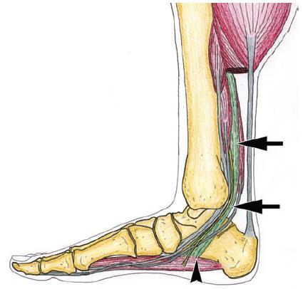 Tarsal Tunnel Syndrome: FDAL Flexor Digitorum Accessorius Longus Origin: variable (any structure in the posterior compartment) Medial margin of tibia Fascia of