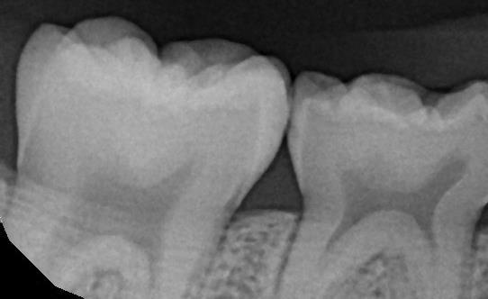 Evidence-base for Resin Sealants vs Glass Ionomer Sealants Caries prevention in permanent molars Resin = HVGI Does a sealant on occlusal prevent caries elsewhere?