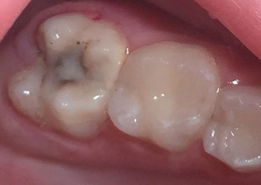 Glass ionomer cement with or without excavation Caries arrest and restoration 2-yr survival = 80% - 93% Expert