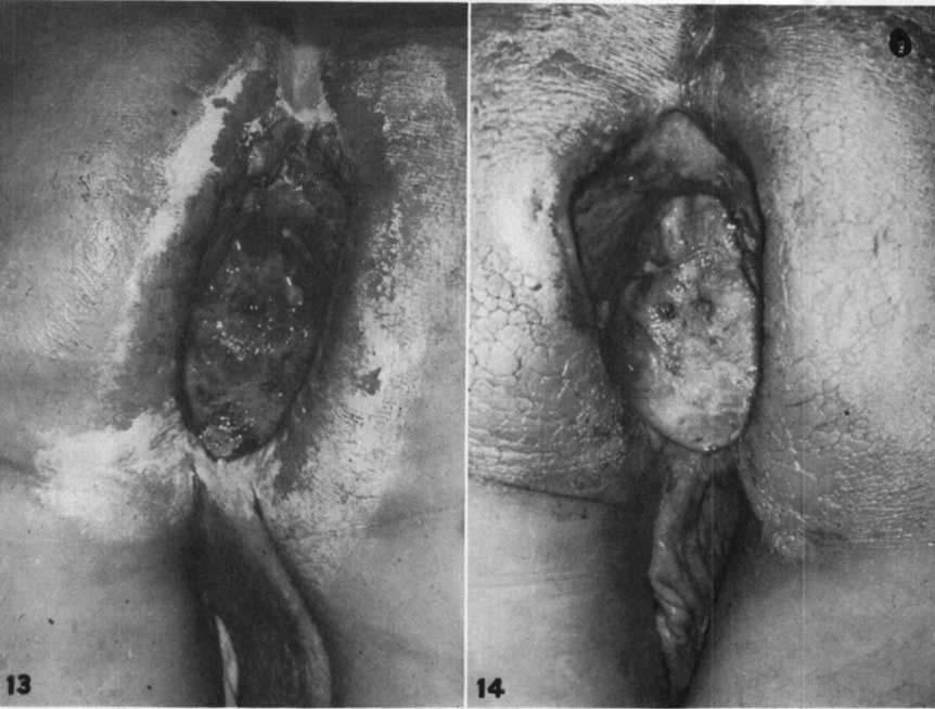 INTRAARTERIAL NITROGEN MUSTARD Bmlberio, Klopp, Ayres, d~ Gvoss [1353 FIG. 13. Recurrence of rectal adenocarcinoma in perineal wound following abdominoperineal resection.