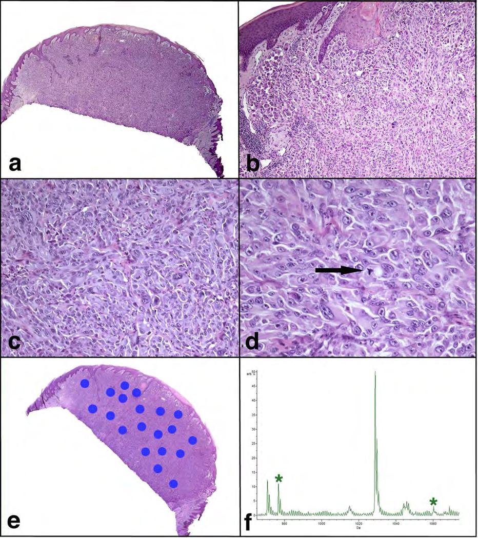Lazova et al. Page 13 FIGURE 2. Atypical Spitzoid Neoplasm diagnosed as Spitzoid melanoma by histopathological examination and as Spitz nevus by IMS.