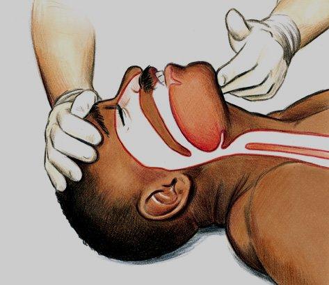 V)RESPIRATORY EMERGENCIES A) AIRWAY OBSTRUCTION 1) Methods to open the airway in unconscious patient tongue blocks