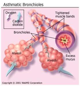 B) ASTHMA 1) Hyperreactivity of the tracheobronchial tree 2) Pathologic processes (a) Bronchial smooth muscle contraction (b) Bronchial wall edema (c) Mucus hypersecretion 3) Triggers in dental